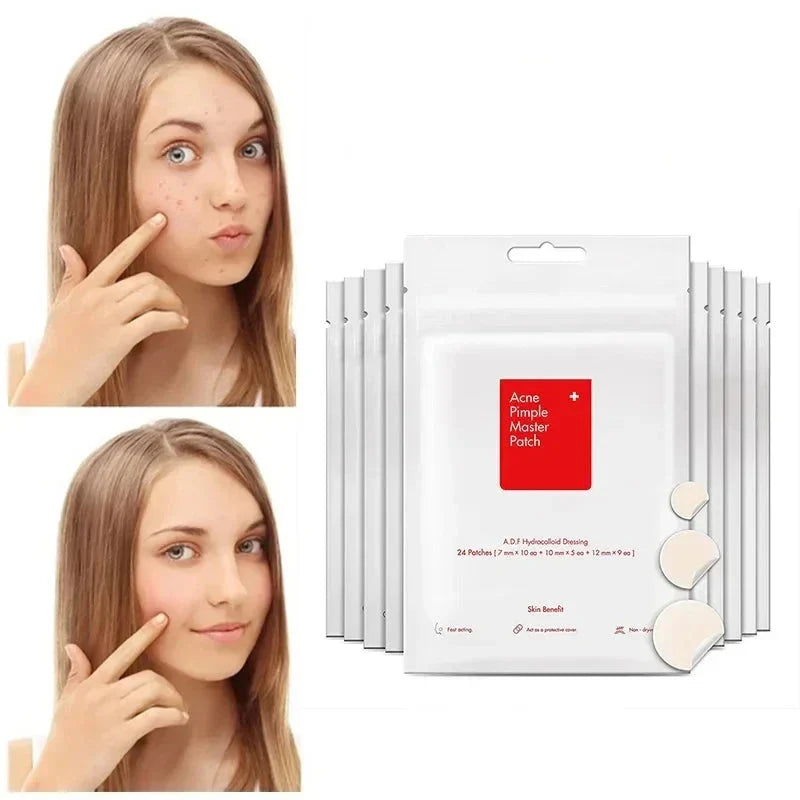 Acne Spot Treatment Patches